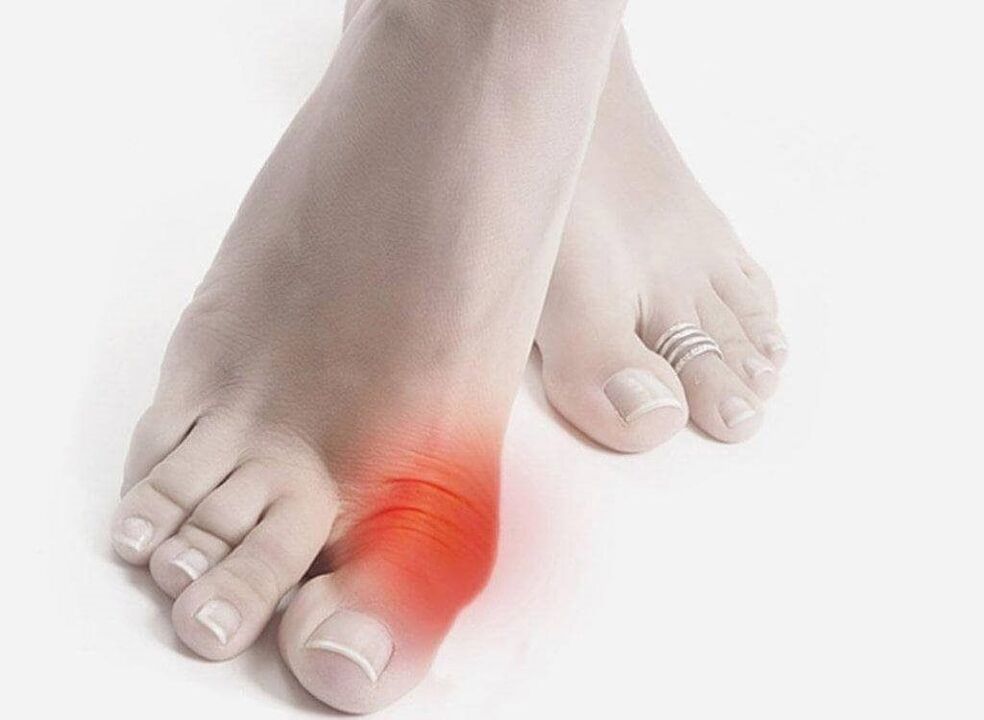 симптомы подагры ног